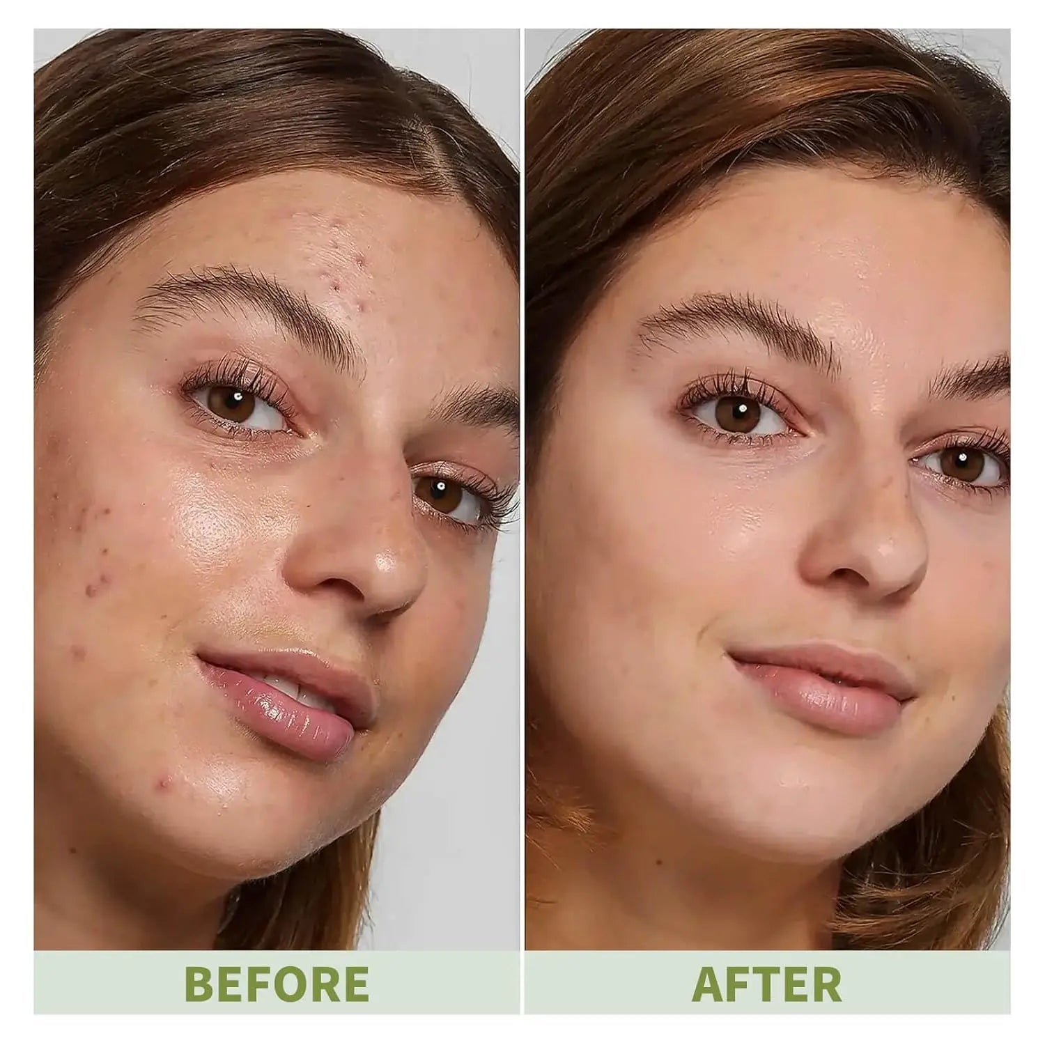 VGO Relief Acne Spot Essence Anti-Acne Serum, 12ml / 0.4oz… VGObeauty